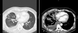 DIAGNOSTIC AND THERAPEUTIC ASPECTS IN MALIGNANT Pleural mesothelioma